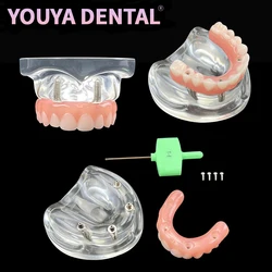 1 szt. Ząb górnopalczarny implantu dentystycznego 4 śruby z mostkiem słupkowym wymienny model odbudowy Typodont dla demonstracji dentystycznej