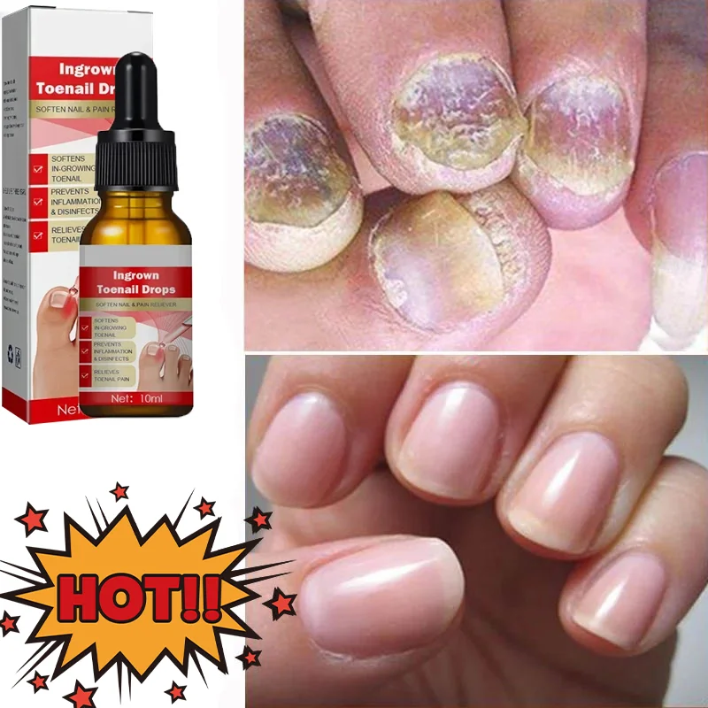 

Fungal nail care massage essential oil Fungal treatment serum