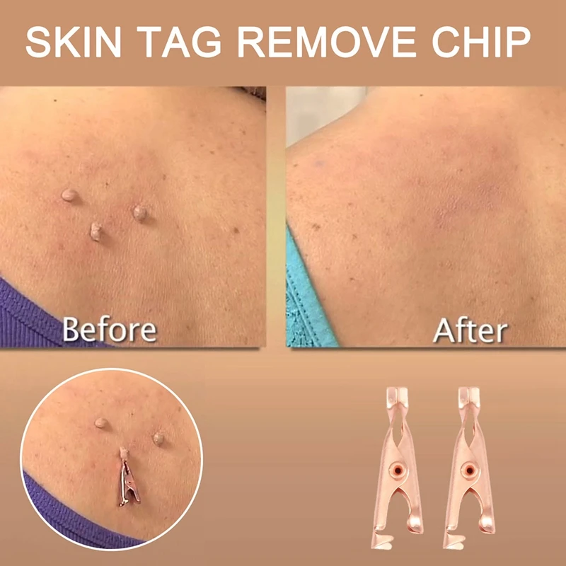 BAADE 1 صندوق/12 قطعة مقاطع إزالة علامات الجلد النحاسية ثؤلول العلامة النازع النحاس العلامة خارج أداة إزالة علامة الجلد