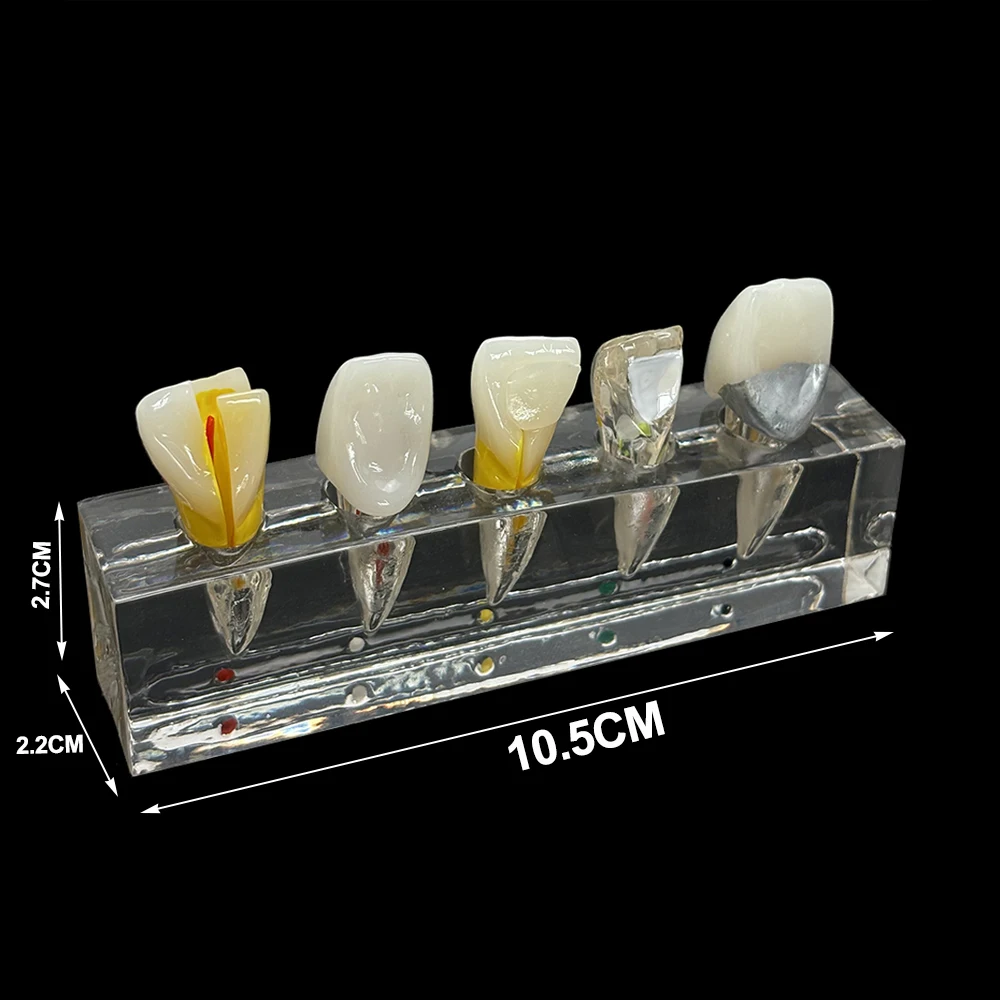 Dentist Tooth Models Endodontic Pathological Anterior Front Labial Teaching  Orthodontic Model Dentistry Dentist Demo Studying