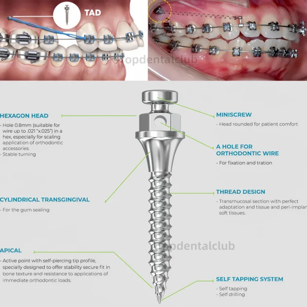 

Ортодонтические мини-импланты TADs и винты для крепления брекетов к кости