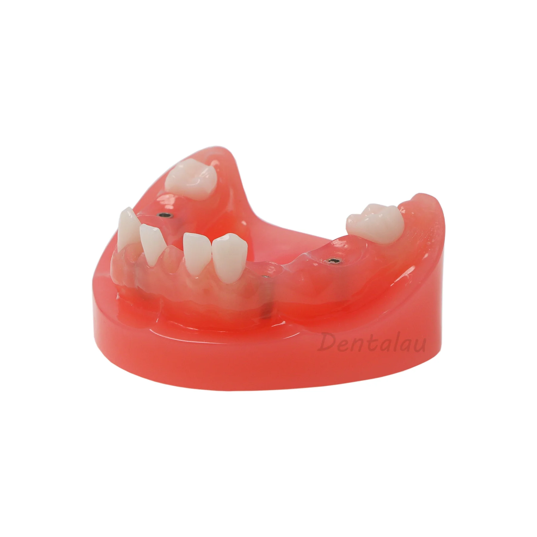 Dental Typodont Implant And Restpration Model With 4 Screws Low Jaw Type M6019