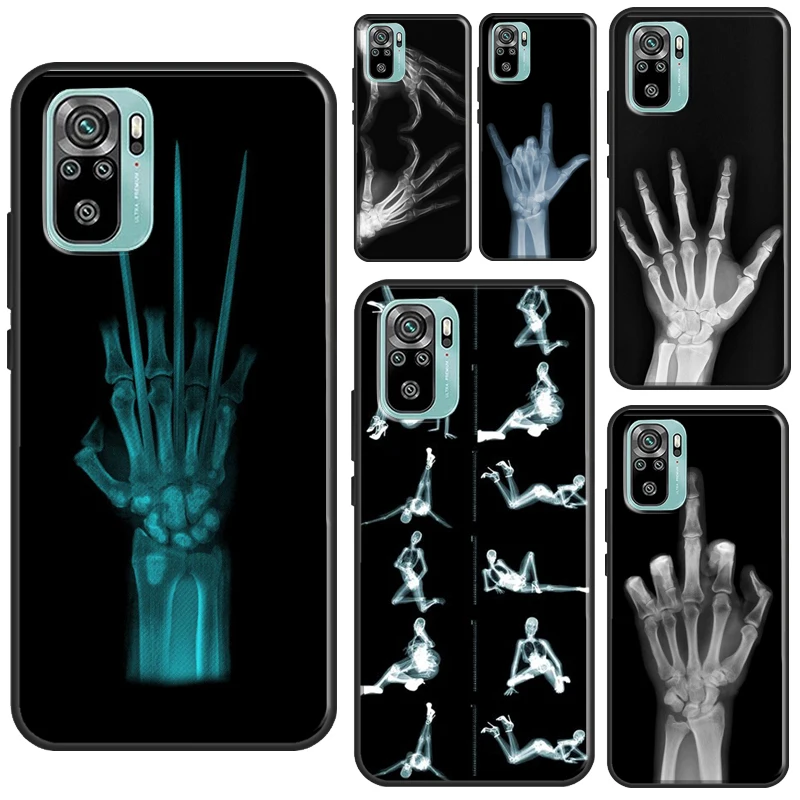 X-ray Hand Bones Case For Xiaomi Redmi Note 12 Pro 8 9 10 11 Pro 9S 10S 11S 12S Redmi 12C 10C 9C 10A Cover