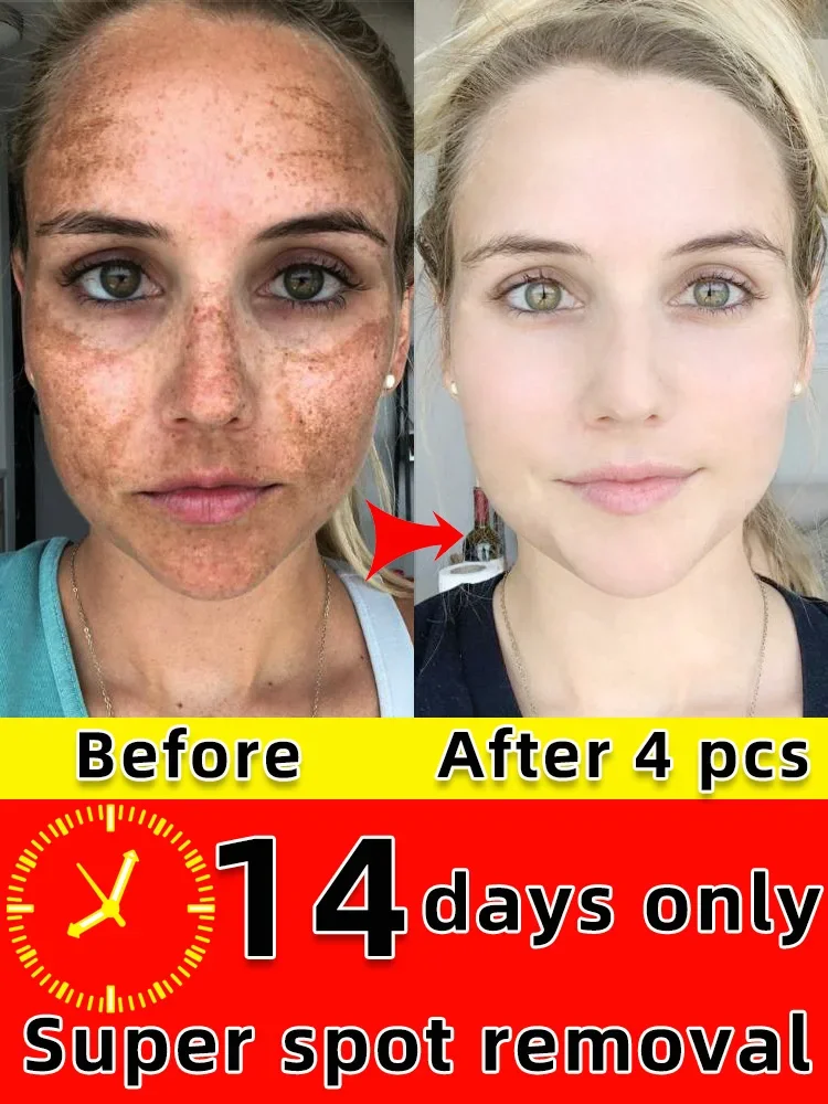 Freckles Removal Cream Remove Facial Spots Skin Dark Spot Remove Melasma Age Spots Sunspots Whitening And Freckle Removing Cream