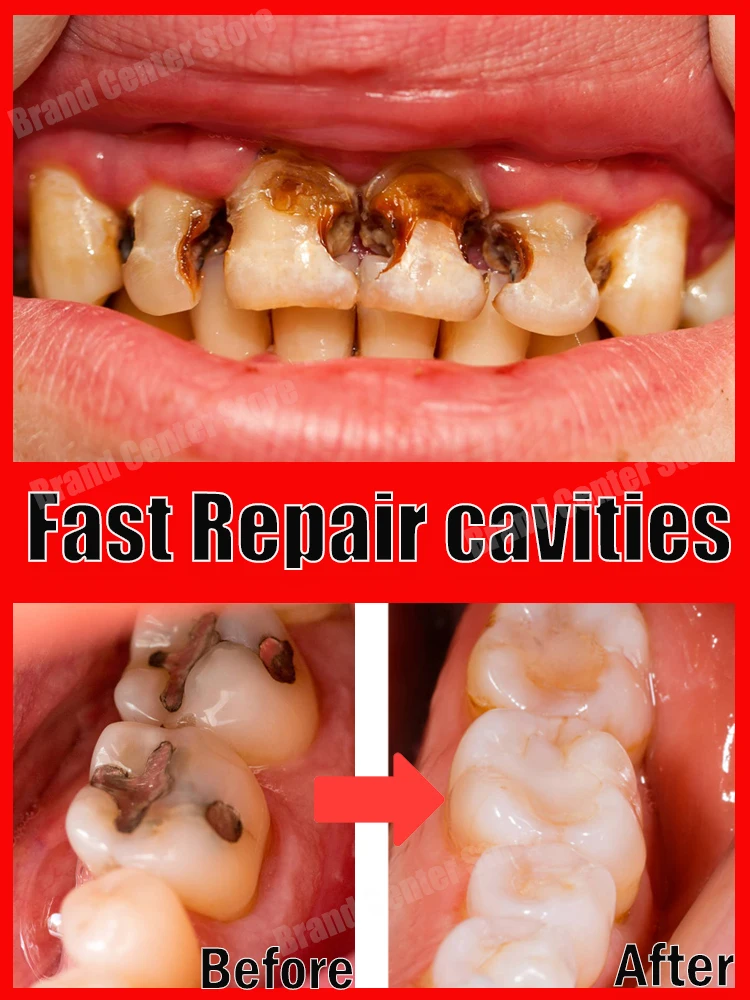 

tooth decay repair cavities protect teeth