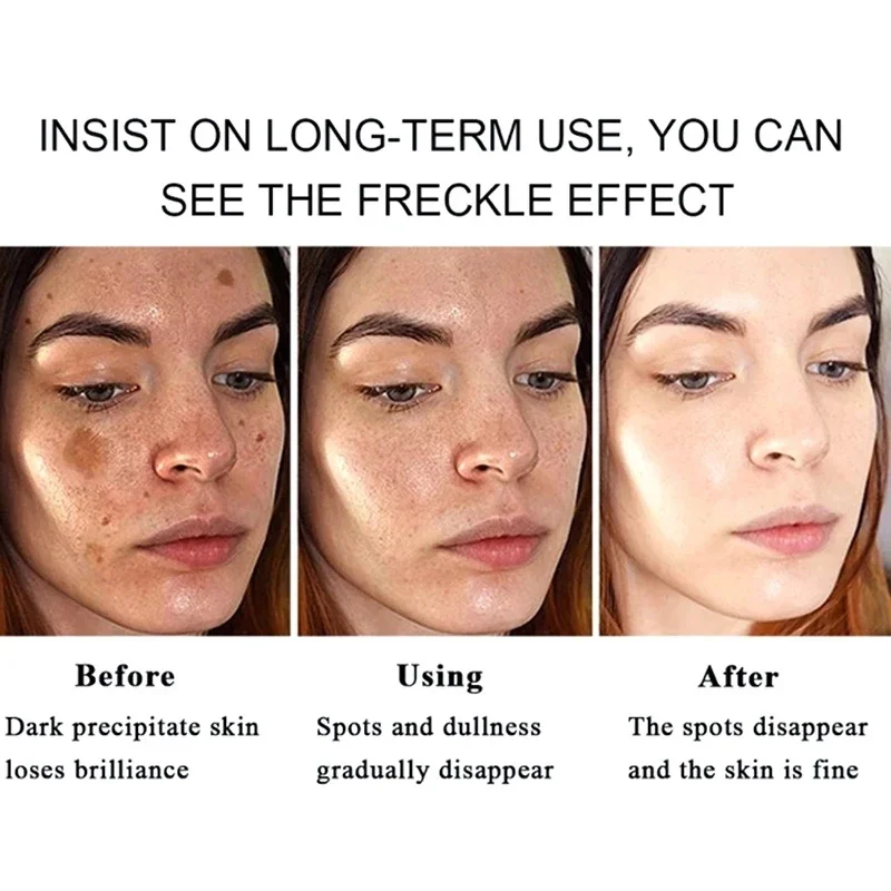 Freckle Removal Cream Face Dark Spot Melasma Remover Lighten Pigmentation Brighten Products Moisturizing Whitening Skin Care