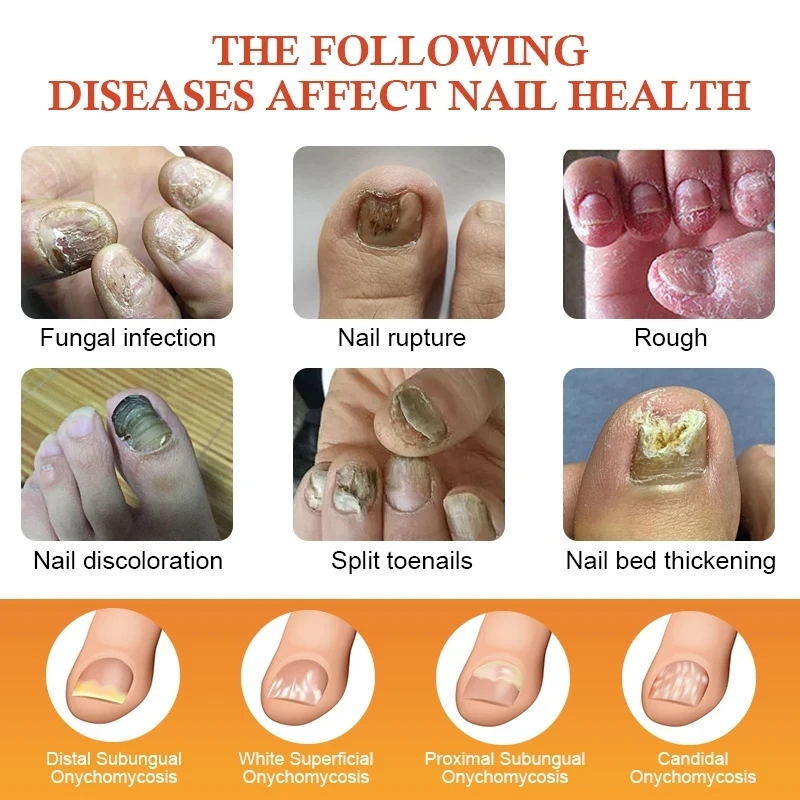 Pilz Nagel Behandlung Essenz Fuß Nagel Pilz Entfernung Reparatur Serum Anti Infektion Paronychie Onychomykose Fuß Nagel Pflege Creme
