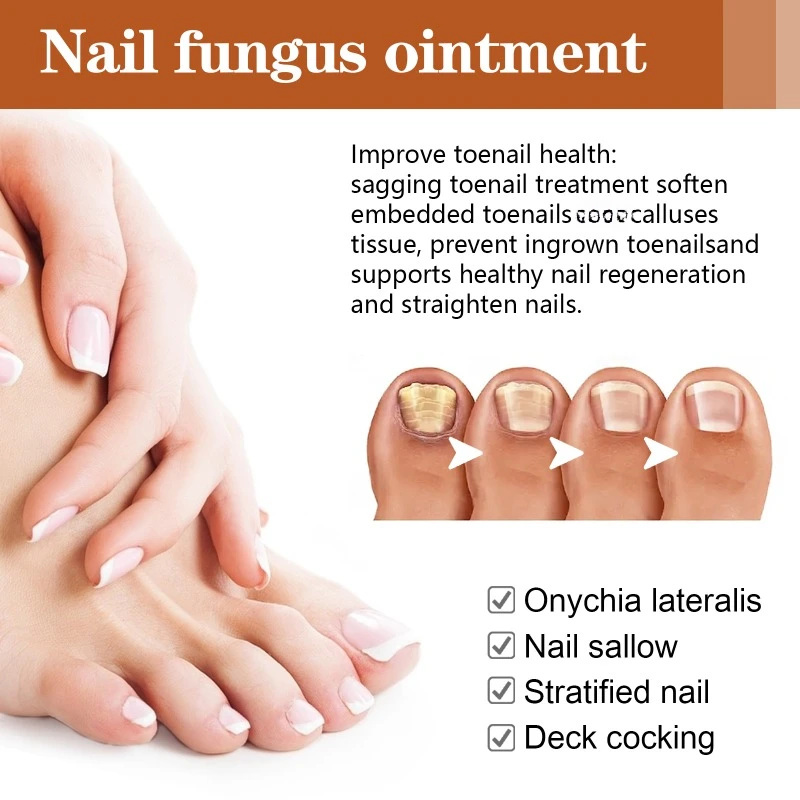 Anti-nail groove relief Essential oil repair ingrown toenail onychomycosis Fungal Treatment thickening soft nails Infection care