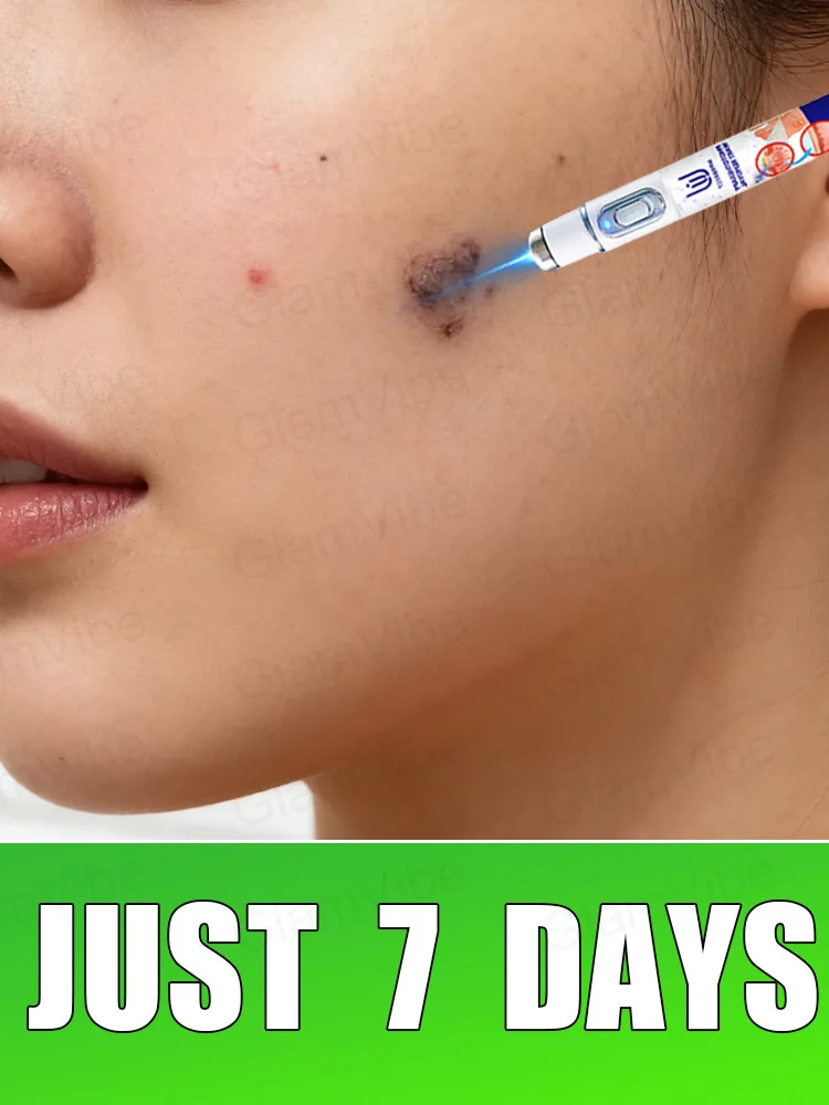 Outil de résolution de verrues au Laser bleu, nouvelle mise à niveau 2025