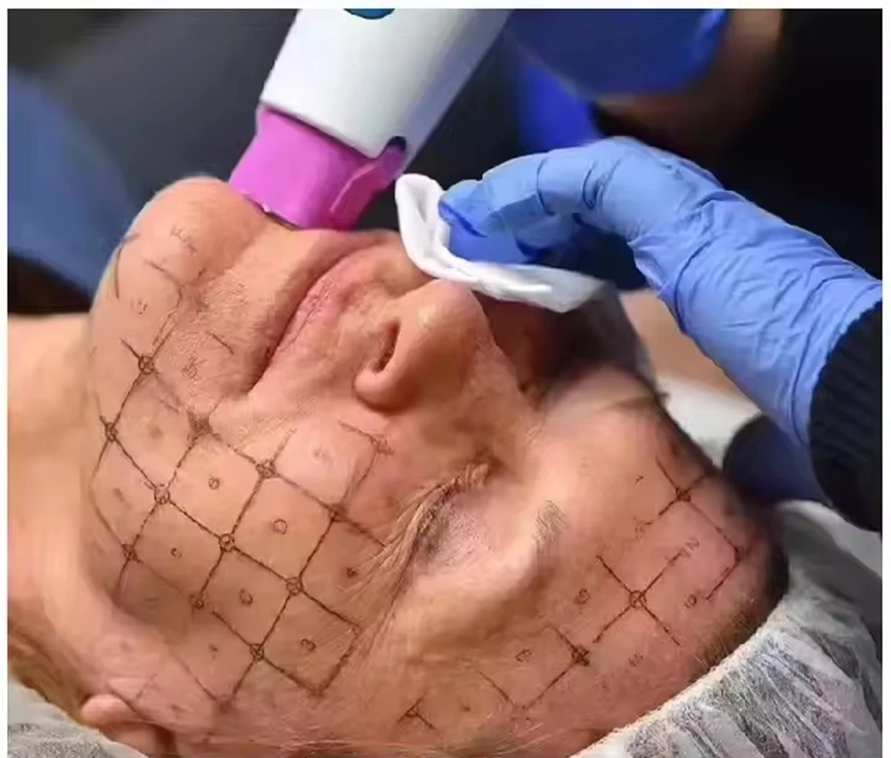 Factory Price Non Invasive Anti-aging Facial Lifting and Firming Beauty Skin Firming Machine Equipment