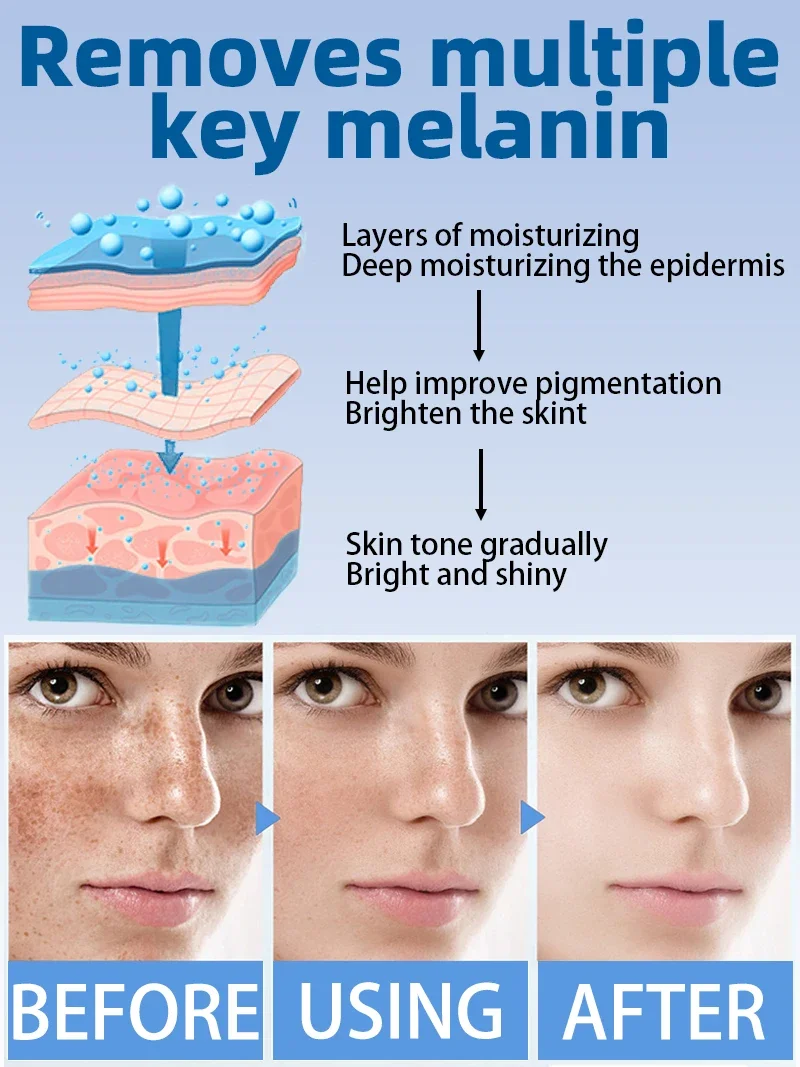 Freckles Melasma Chloasma Dark Spot