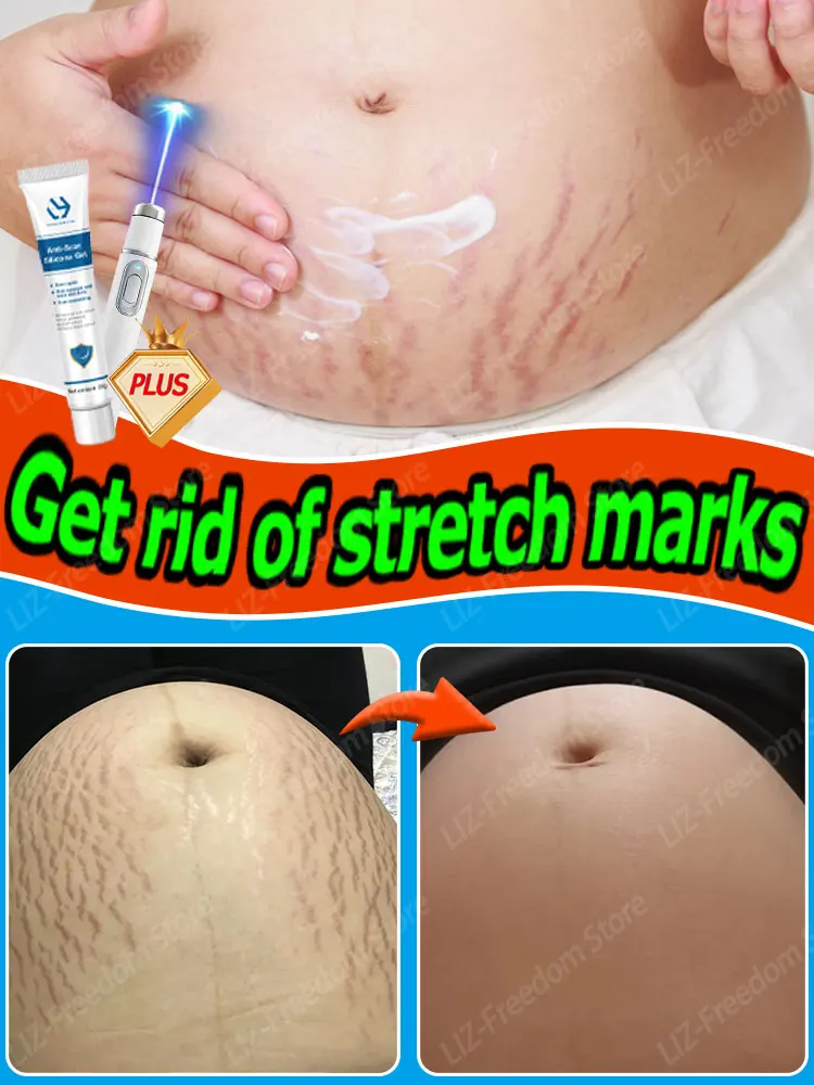 

Pregnancy Stretch Marks Maternity Cream