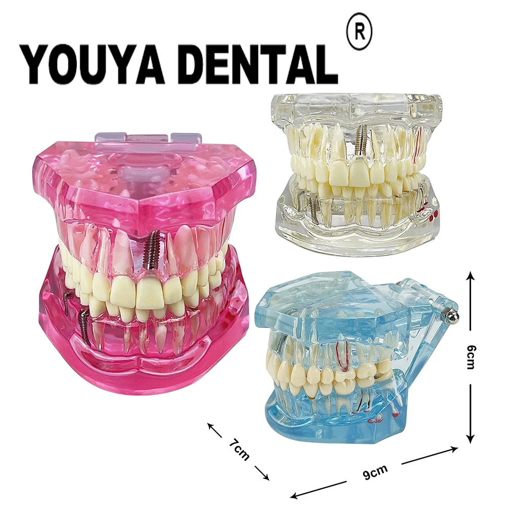 Teeth Repair Model Disease Teeth Model for Dentist Student Practice Training Studying Oral Medical Dentistry Tools