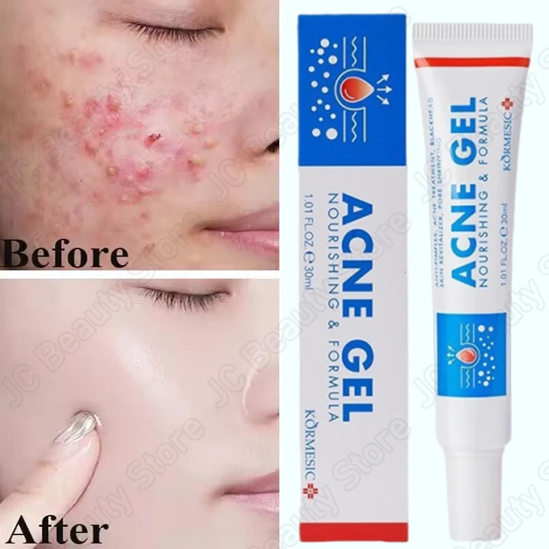 Salicylic Acid Acne Treatment Face Cream Repair Pimple Spots Deep Cleaning Pore Anti-acne Scar Oil Control Moisturizer Skin Care