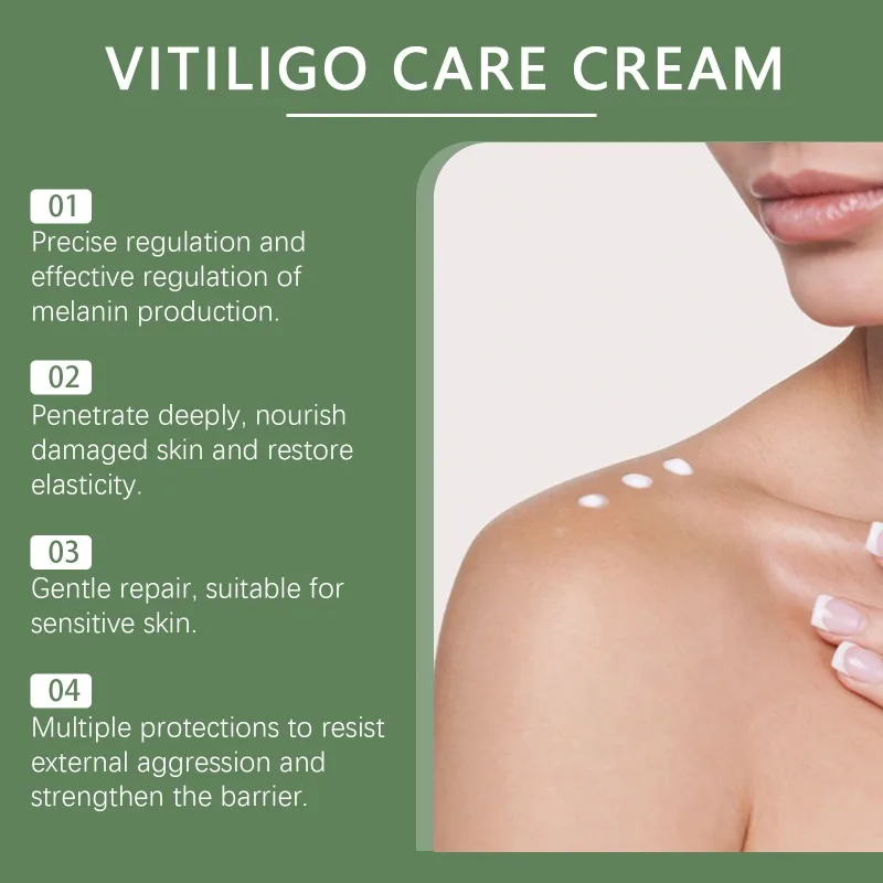 Vitiligo Treatment Cream Remove Ringworm White Spot Sweat Spots Relief Moisturizing External Body Skin Tone Care Treatment 30g