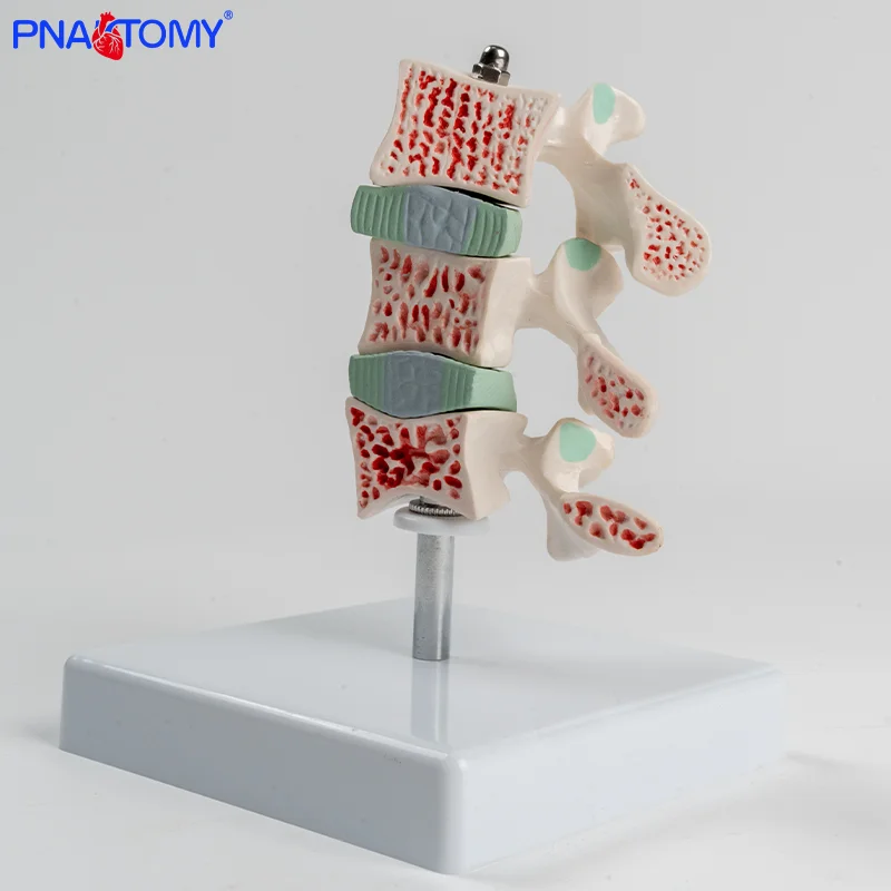 

Human Skeletal Osteoporosis Lesion Model Spinal and Cervical Vertebra Anatomical Model