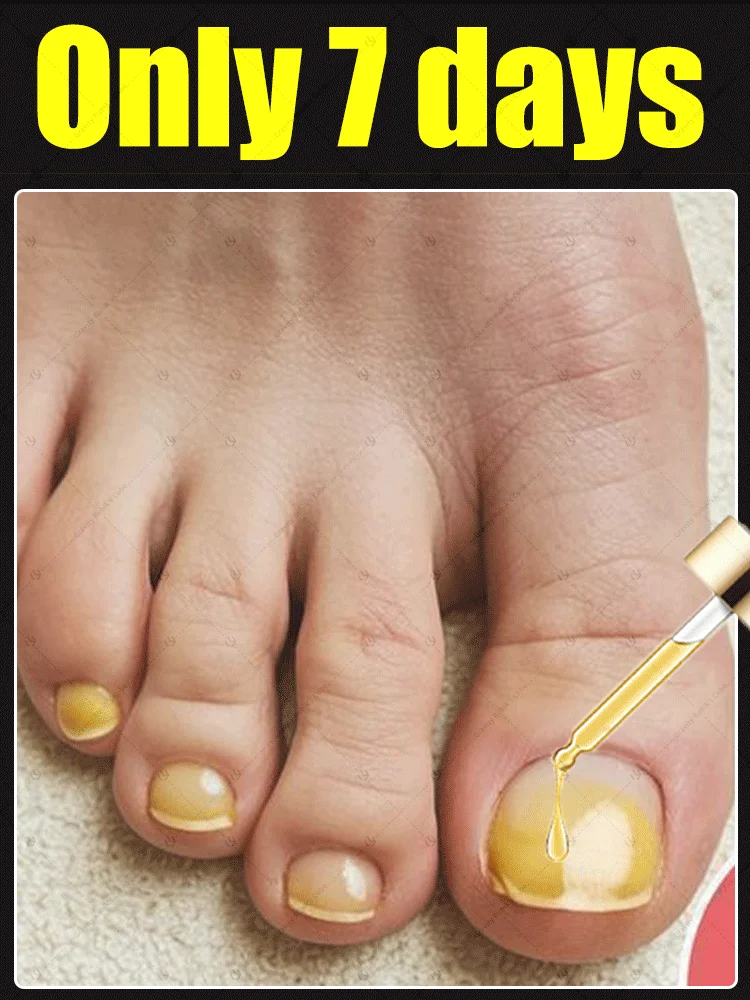 

2025 Toenail Fungus Patch Waterproof Nail Repair Patches Nail Ingrown Correction Sticker Discolored Damaged Nail Foot Care Tool