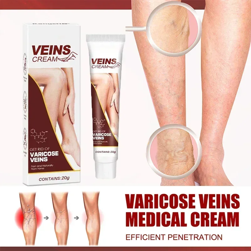 ⁿⁱᶜᵉ Varicose Vein Treatment Leg Vein Health Ointment, Effectively Removing Spider Veins2210