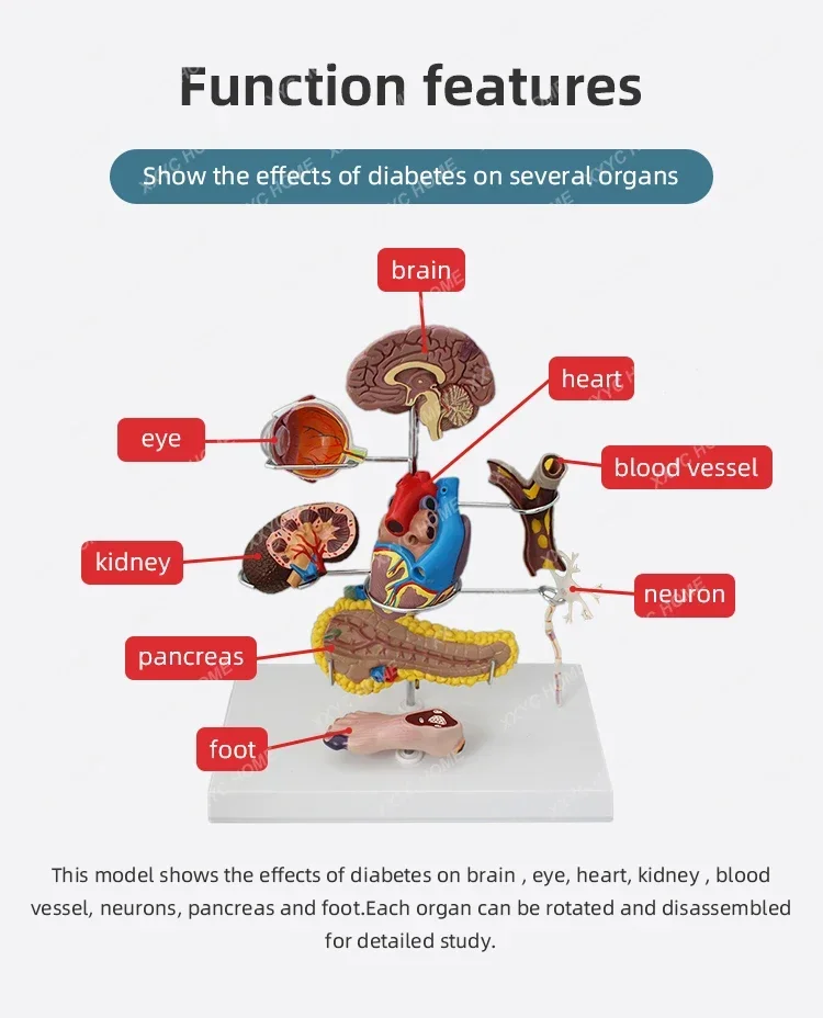 FORESTEDU Diabetes Model Teaching Anatomical Pathology Model 8 Parts Effects of Diabetes Details High Quality Pancreas Anatomy