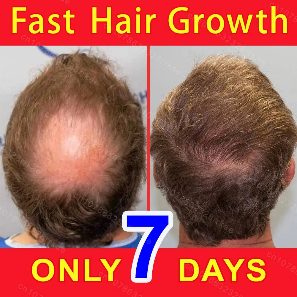 Fast Hair Growth for Men Women Hair spray  Anti Hair Loss Products   Scalp Treatment Repair Nourish Damaged Hairs Scalp