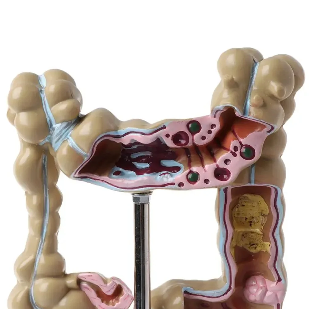 Colorectal Lesion Model Human Colon Snake Large Intestine Pathological Diseases Model Medical Organizer Anatomy Drop Shipping