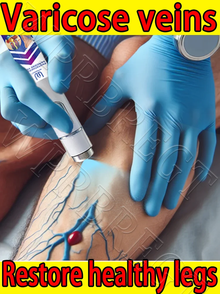 

Quickly overcome varicose veins without surgery