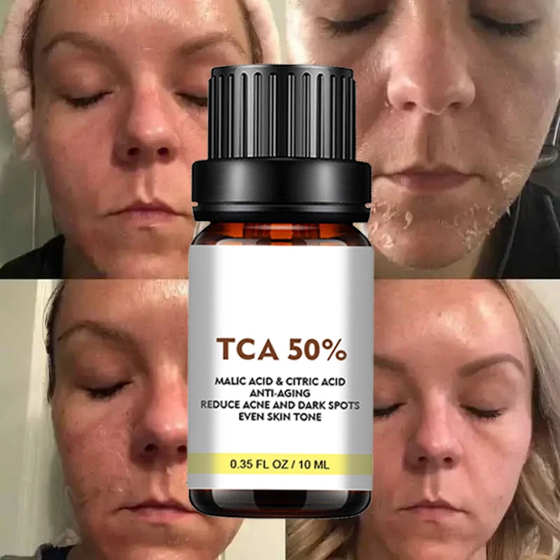 جوهر العناية بالبشرة الميتة، زيت التقشير المبيض الأصفر، إزالة الجلد الداكن، إزالة الميلانين للساق والركبة