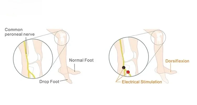 

Stimulation-Based G4 System for Foot Drop Neuromuscular Wearable