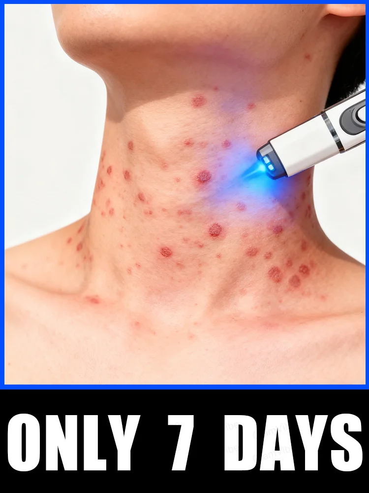 

2025 New Upgrade Blue Laser Solve Wart Tool