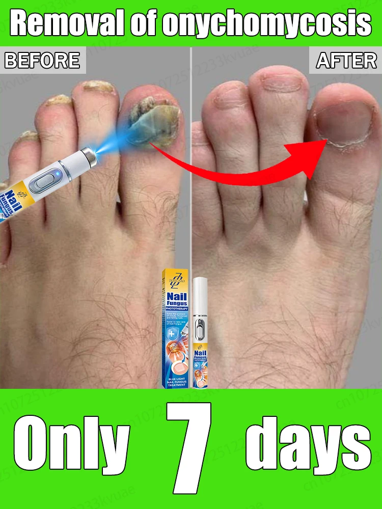 

Say goodbye to onychomycosis scientifically and safely