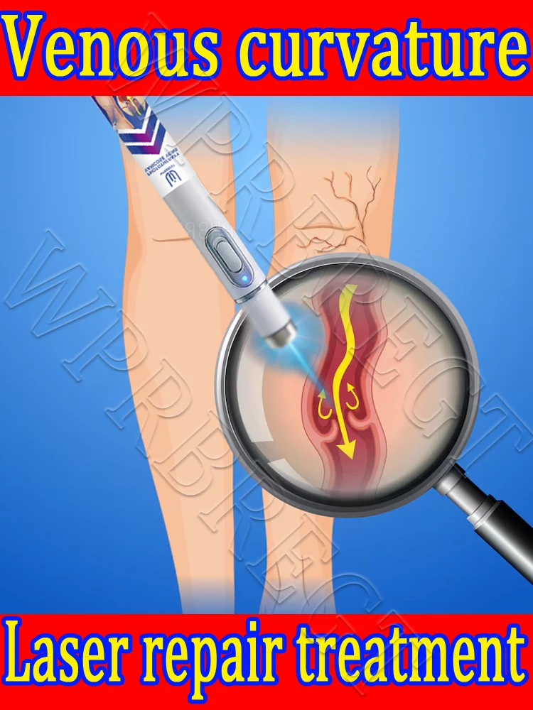 

Безболезненное лечение варикозного расширения вен