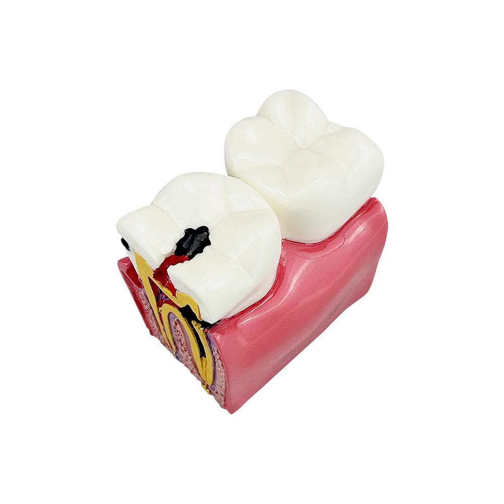 6 Times Molar Pathology Anatomical Model Dental Comparison Model For Dentist Patient Communication Education Teaching Studying