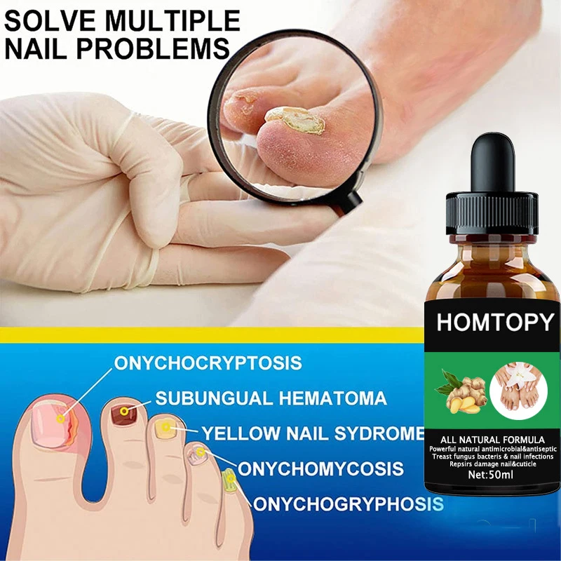 Efficient Nail Repair Solution Treating Cracked Discolored Nails Gray Foot Care Toe Nail Sterilization Gel Nourishing Essence