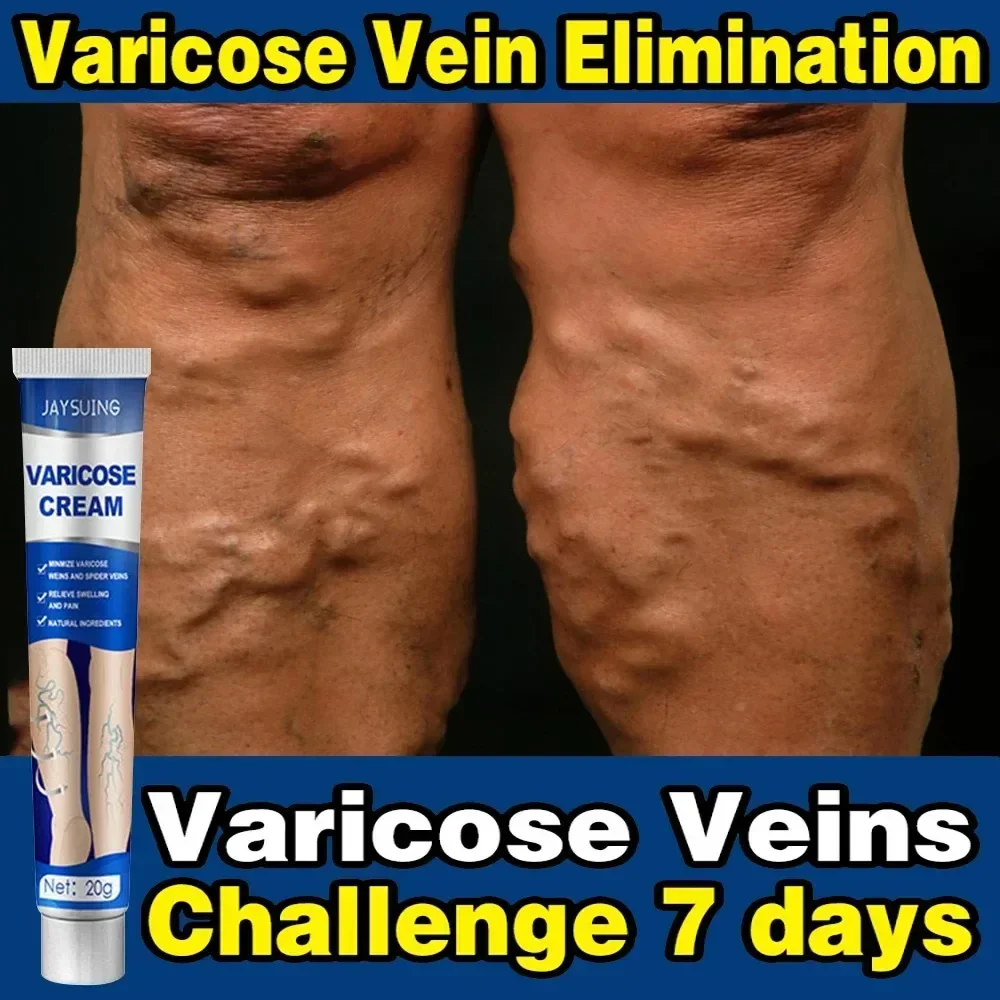 

Varicose Veins Treatment Cream Effective Cure Leg Acid Vasculitis Phlebitis Spider Veins Pain Relief Angiitis Ointment