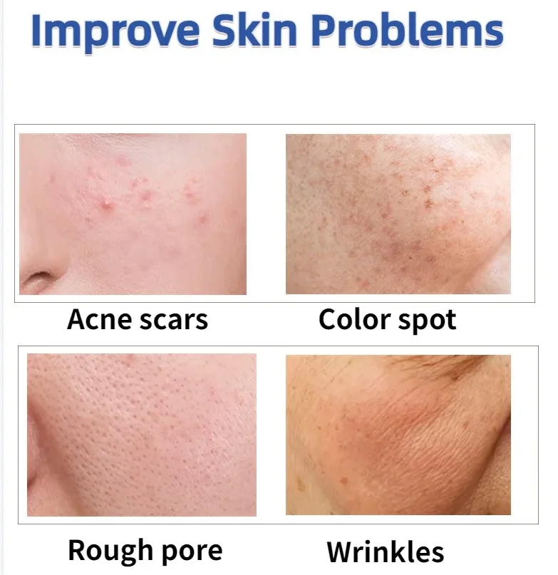 Acne treatment Machine Face Lifting Device Face Neck Lifting Massager