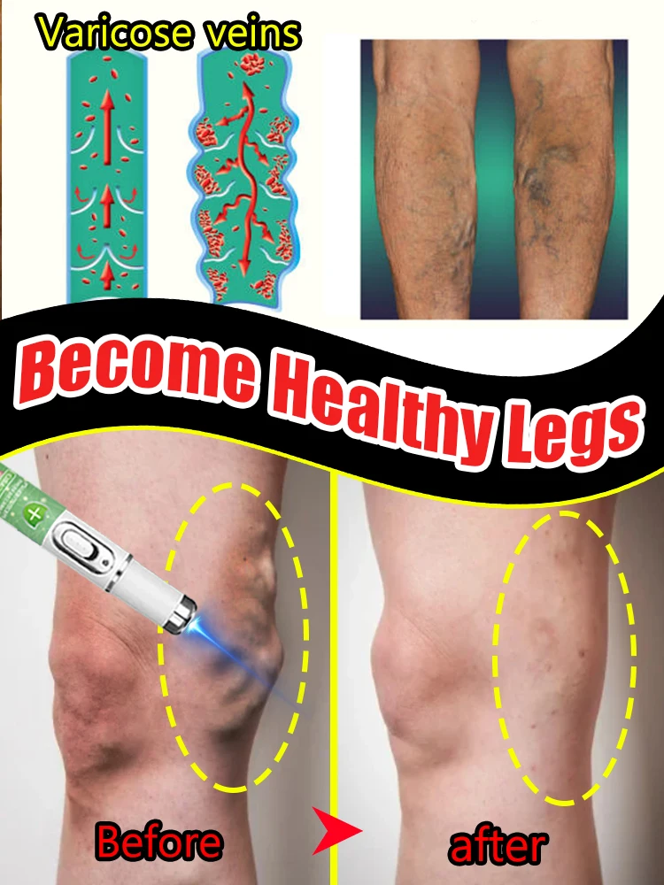 Laser Removes veins