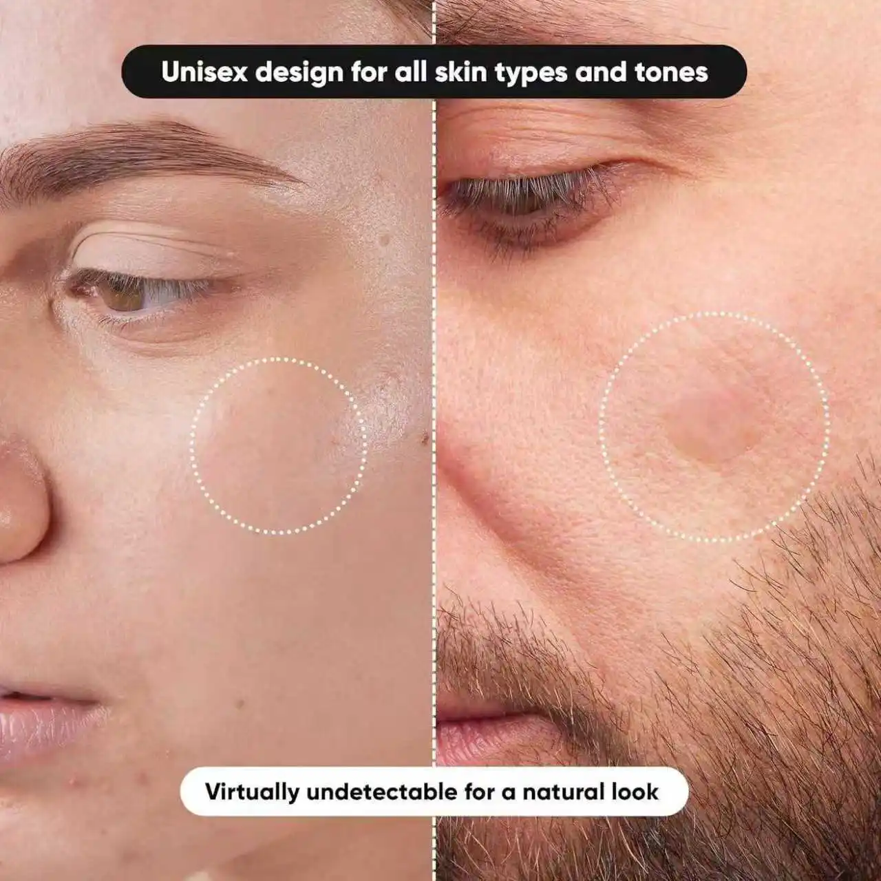 360 pcs/720 pcs face care acne patch set/mild and non irritating hydrocolloid material/containing tea tree oil essence to fade a