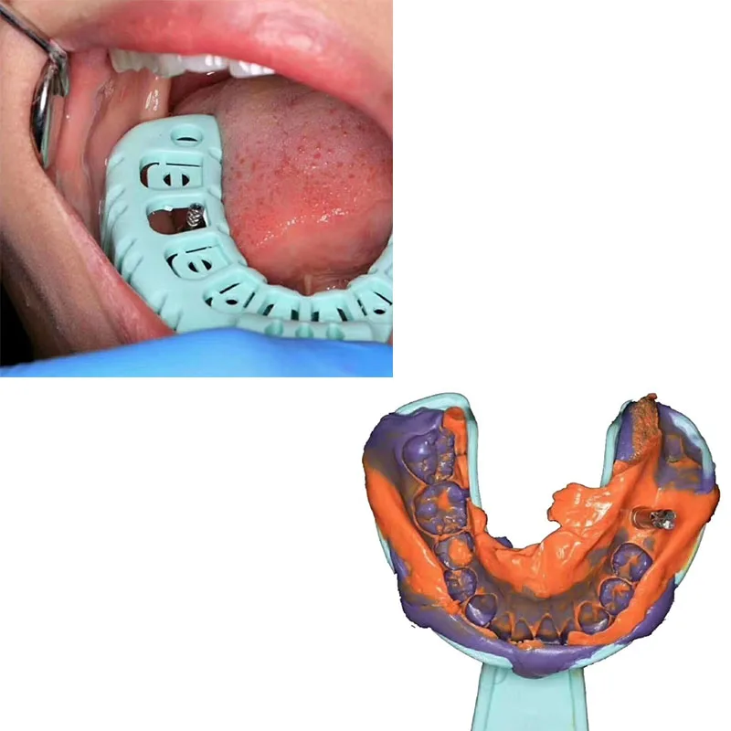 30 par S M L Dental Implant taca zdejmowana forma stomatologia narzędzie materiały laboratoryjne dla technika dentystycznego z tworzywa sztucznego