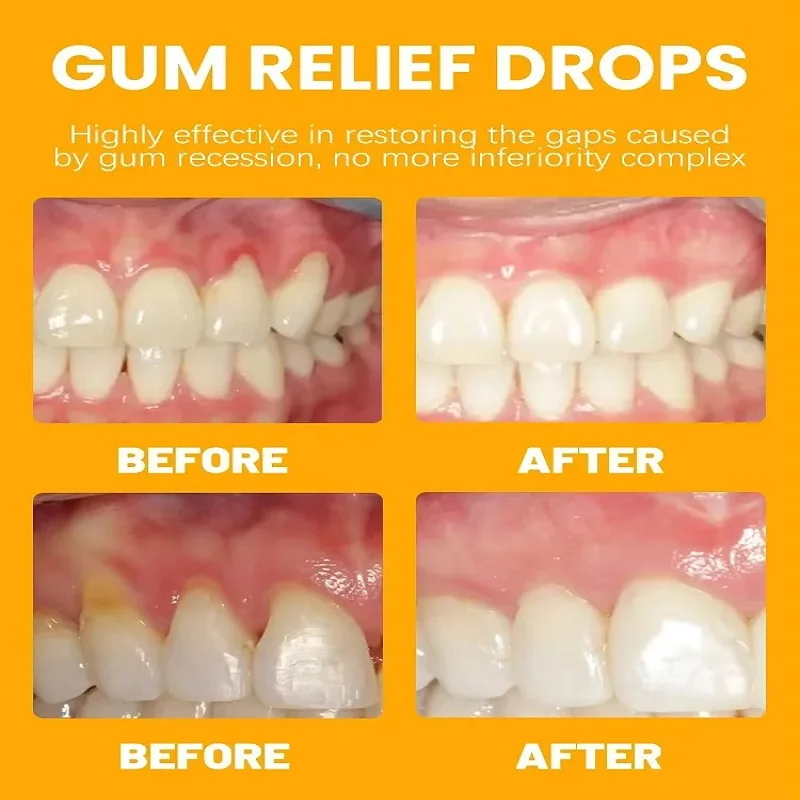 Snelle Reparatie Tandvlees Serum Verlichten Effectief Tand Allergie Tand Cariës Verlichten Tandschade Druppels Gebitsreiniging Tandpasta