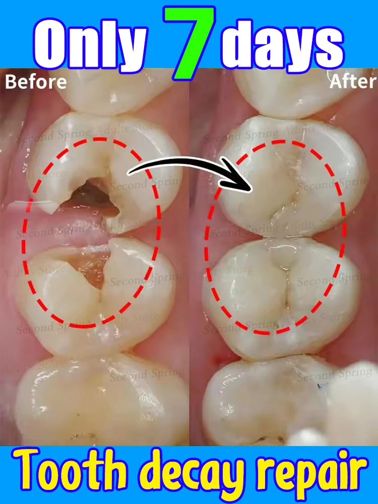 

Tooth decay Repair Repairing Cavities Anti Protecting Caries