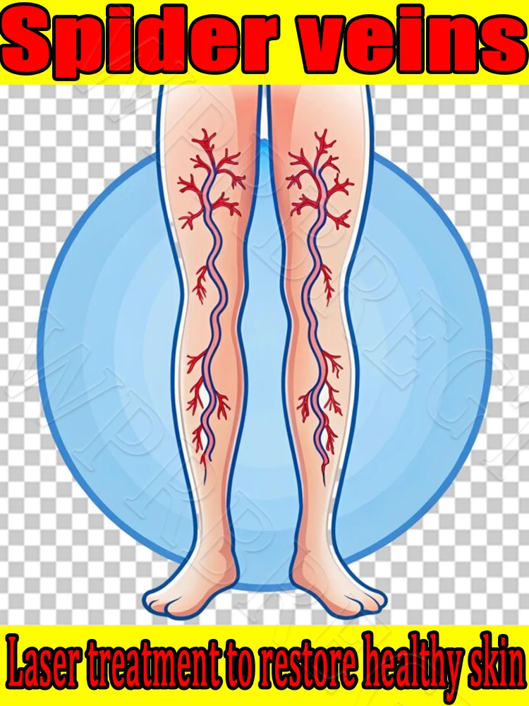 إزالة الأوردة العنكبوتية على الساقين