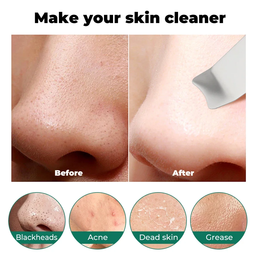 Ultrasonic Skin Scrubber Deep Vibrating Cleansing Spatula Ultrasonic Ionic Pore Cleanser Blackhead Remover Shovel Skin Care Tool