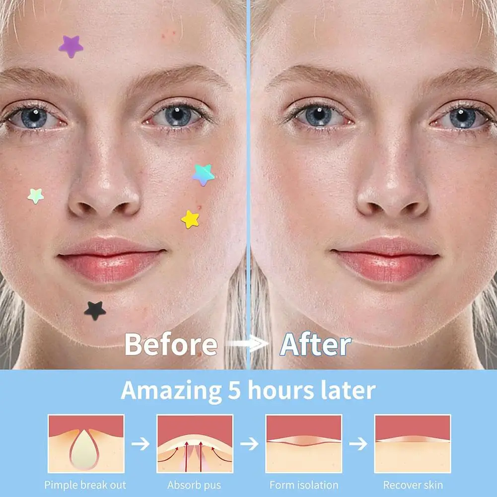 Star Acne Patch Blackheads And Closed Comedones Improve Acne Skin Hydrocolloid Acne Beauty Tools Women Cosmetic