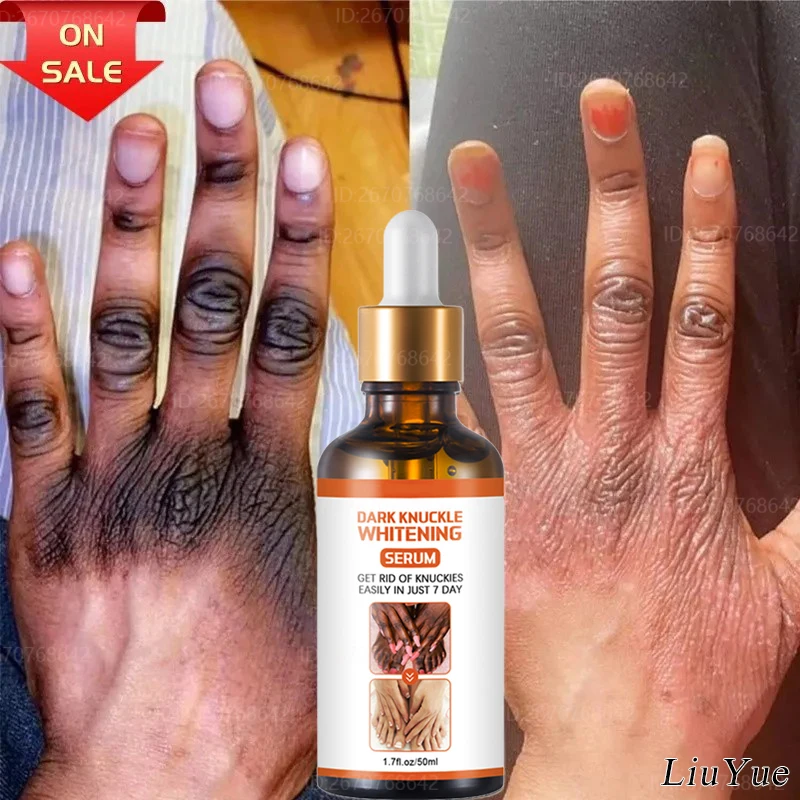 Women Finger Joints Whitening Serum Powerful Removal Melanin Essence Elbows Knee Whiten Serum Dark Skin Brightening Products