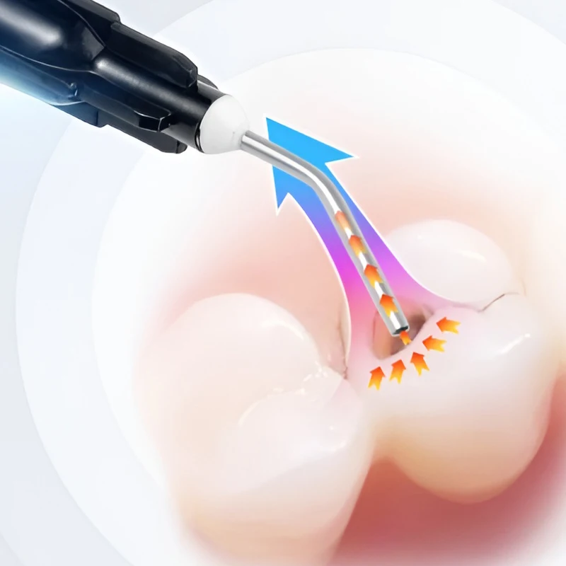 JINGT-Tubo de implante de Metal de succión fuerte para dentista, se puede reemplazar por una aguja de enjuague del Canal radicular reemplazable para Saliva