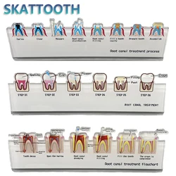 Dental Root Canal Treatment Flowchart Stand for Dental Laboratories Dentist Study Dental Teaching Model Dentist Gift Dentistry