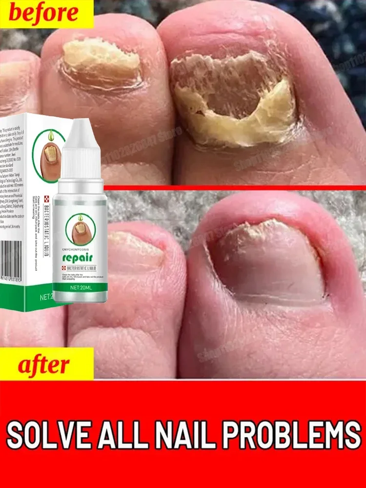 Toenail Nail Fungus Treatment Repair Fingernail Device Toenail Treatment for Foot Nail Fungus Essential Oil Onychomycosis Care