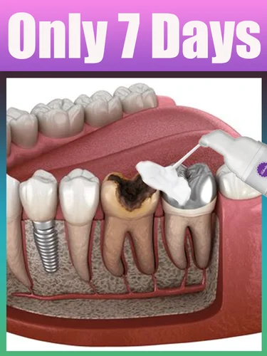 2025 Herramientas de cuidado intraoral Mousse instrumento de lavado bucal