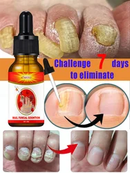 Contains nail fungus essence, say goodbye in 7 days