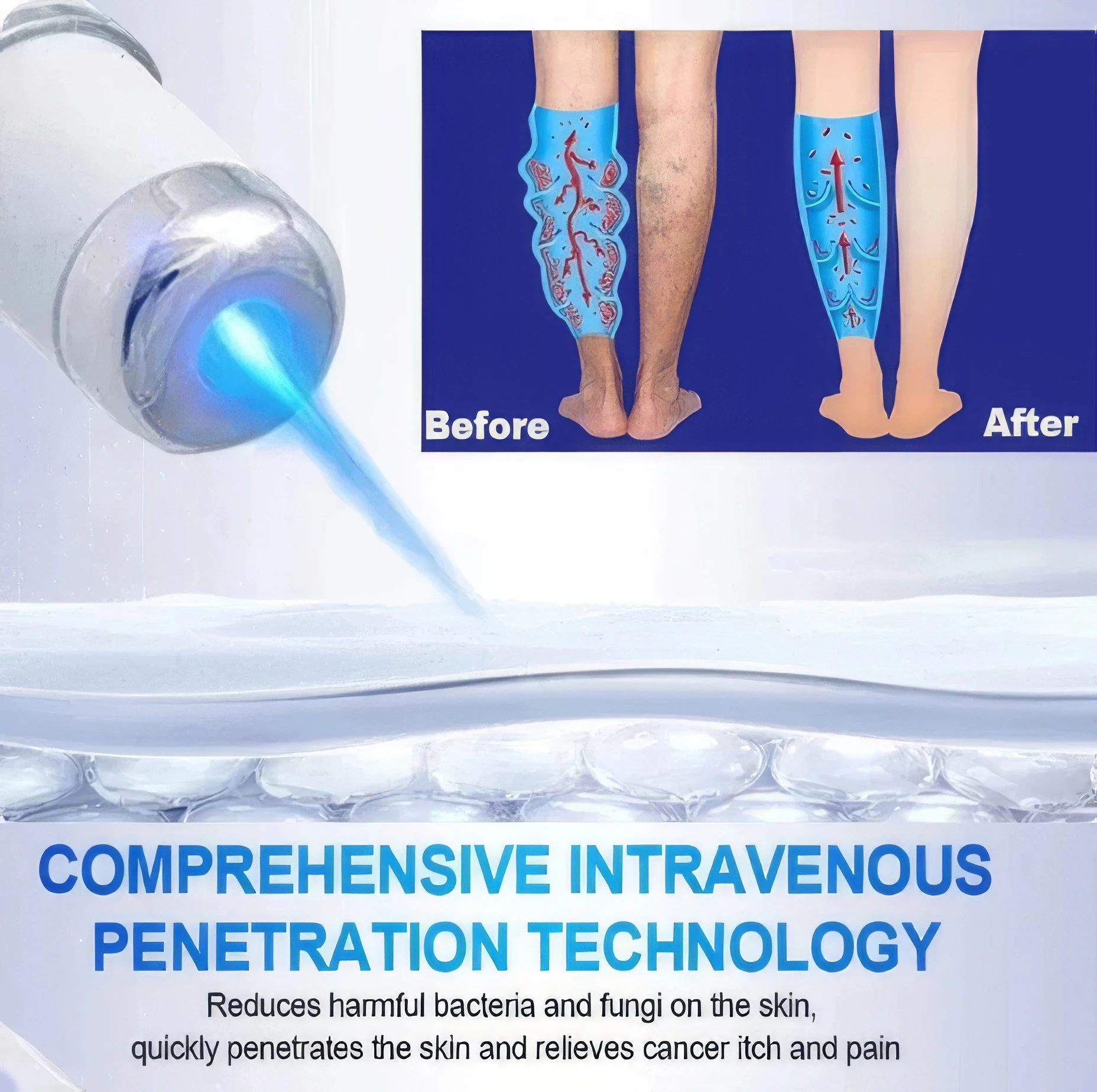 Thérapie au laser pour le traitement des varices, stylo à lumière bleue efficace pour les jambes de Charleroi, la vascularite dilatée, la phlébite, l'amélioration du surpoids de vache